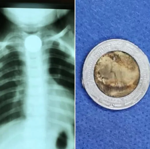 Radiografía de un cuerpo extraño en un niño y el objeto extraído