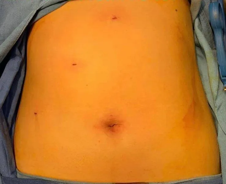 Abdomen tras cirugía de vesícula por mini laparoscopía, con incisiones pequeñas